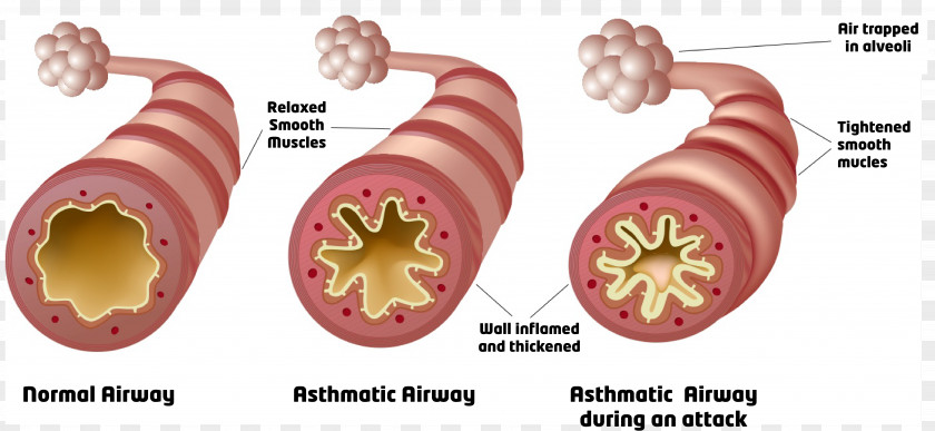 Cardiac Asthma Respiratory Tract Reactive Airway Disease Lung PNG