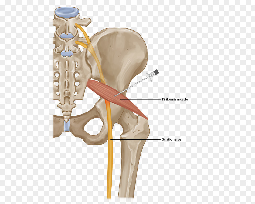 Hip Pain Piriformis Syndrome Muscle Injection Surgery Sciatica PNG