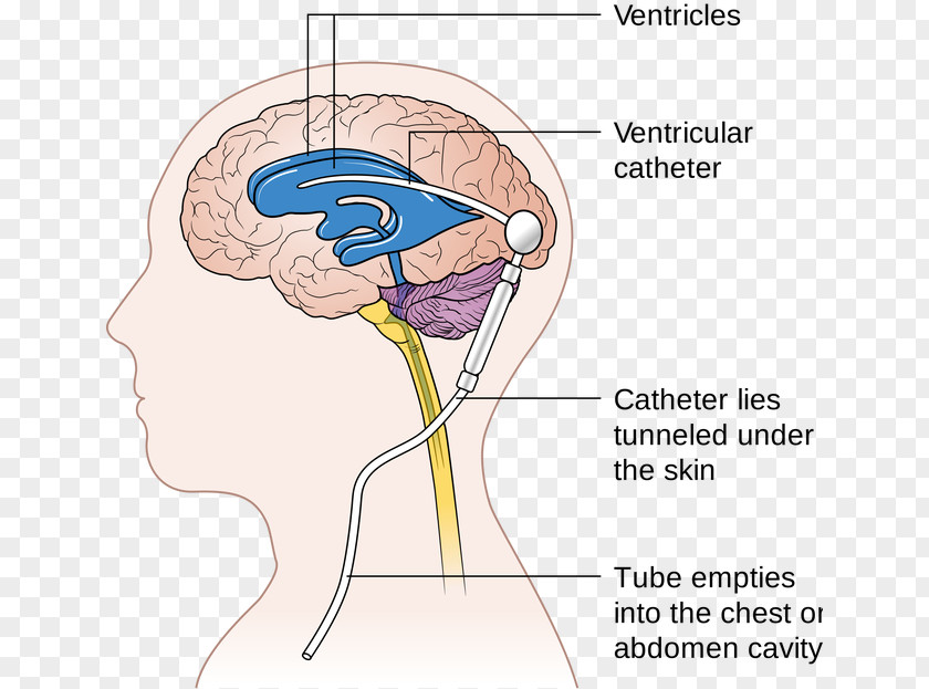 Brain Cerebral Shunt Neurosurgery Hydrocephalus Cerebrospinal Fluid PNG