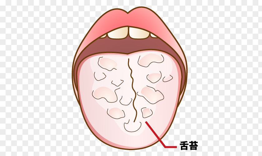 Tongue Mouthwash 歯科 Dentist 坂井医院 Tooth Decay PNG