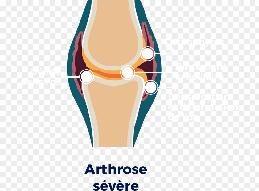 Cartilage Knee Osteoarthritis Hip Shoulder PNG