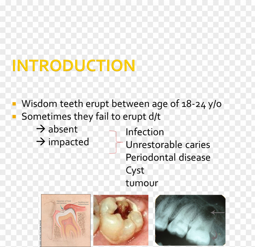 Wisdom Tooth Impacted Teeth Impaction Jaw Molar PNG