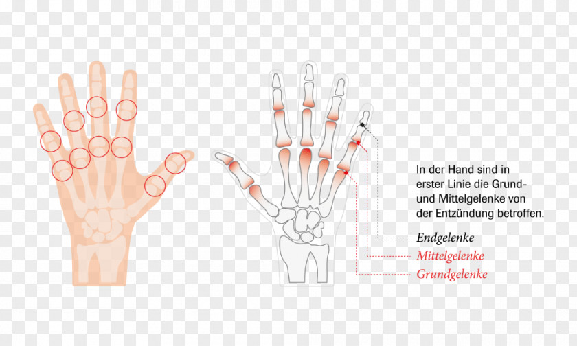 Arthritis Joint Hand Rheumatoid Rheumatism PNG