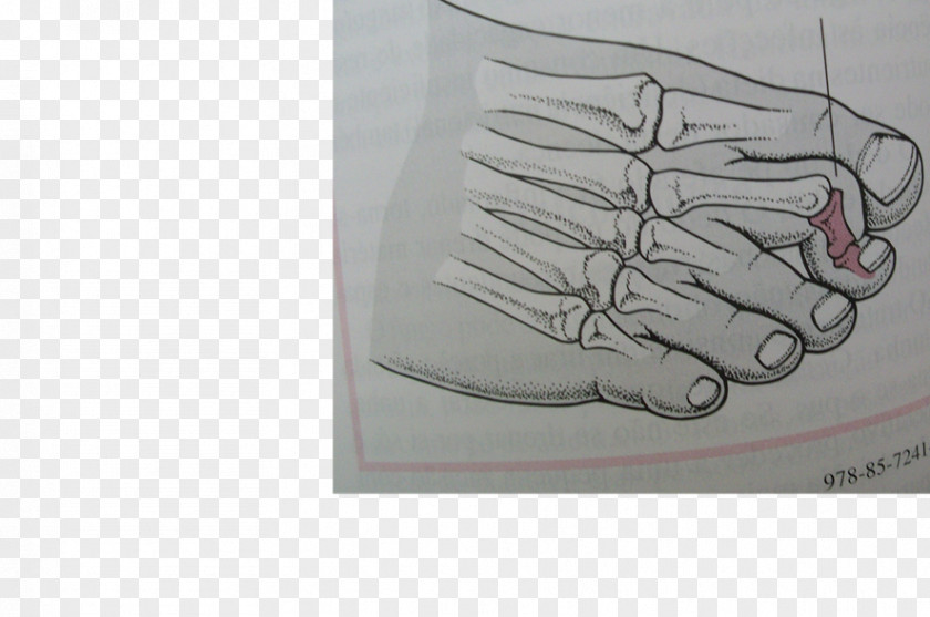 Hand Digit Hammer Toe Foot Mallet Finger PNG