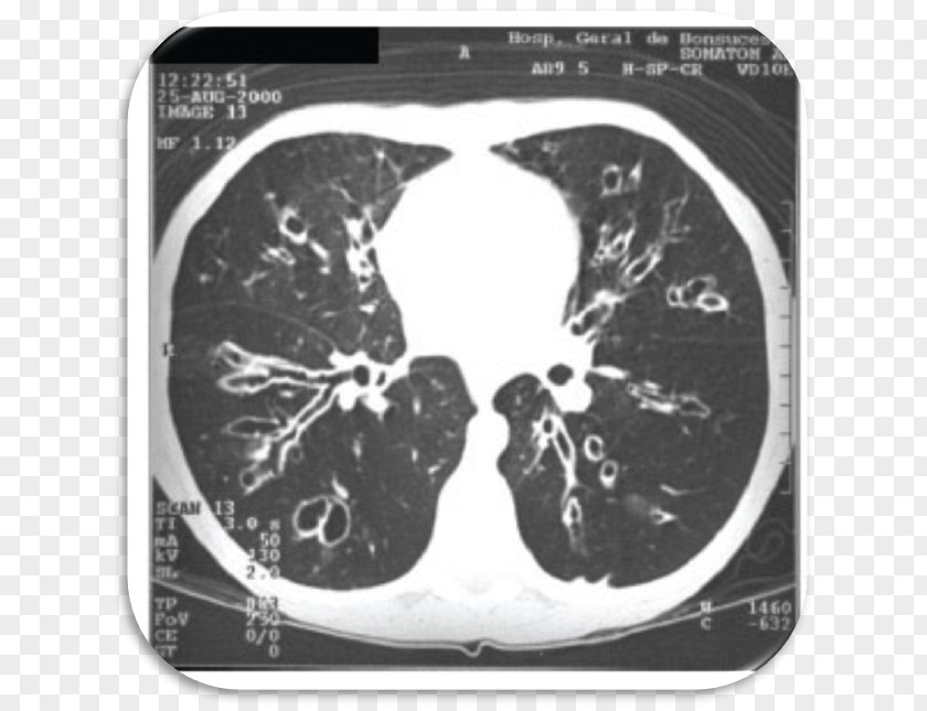 Aspergillus Computed Tomography Radiology Cystic Fibrosis Bronchiectasis PNG