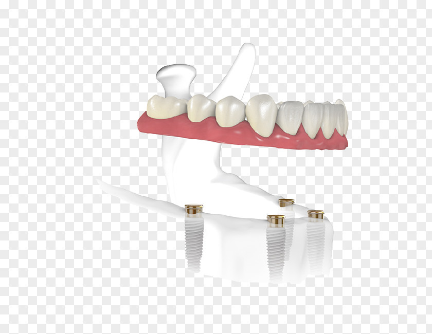 Dental Material Tooth Implant Dentist Edentulism PNG