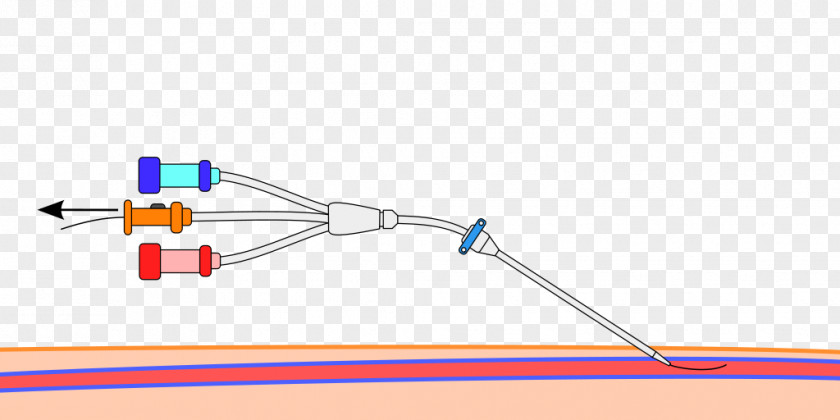 Catheter Seldinger Technique Central Venous Peripheral Trocar PNG