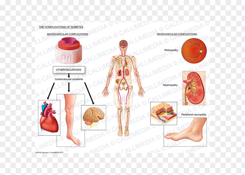 Health Complications Of Diabetes Mellitus Medicine Type 1 PNG