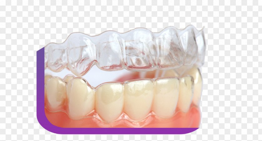 Clear Aligners Dental Braces Dentistry Tooth Orthodontics PNG