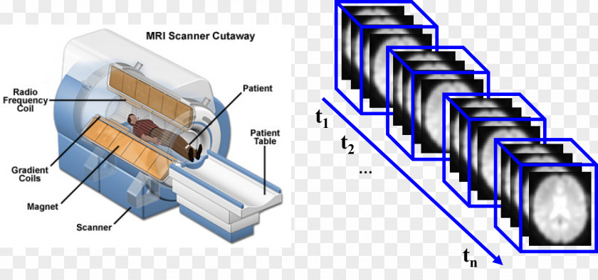 Alzheimer's Disease Magnetic Resonance Imaging Medical Computed Tomography MRI-scanner Radiology PNG