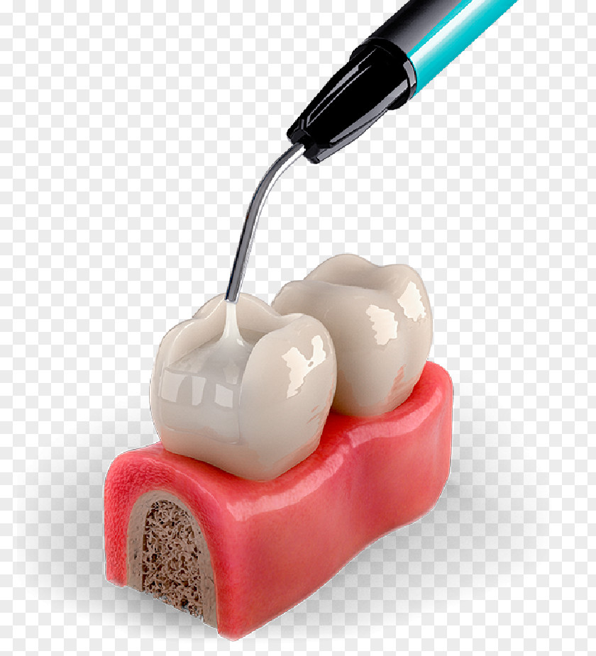 Dental Material Tooth Decay Dentistry Neck PNG