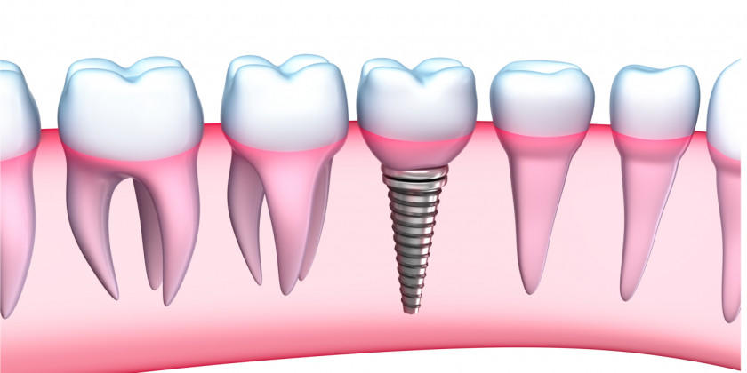 Teeth Dental Implant Dentistry Human Tooth Dentures PNG