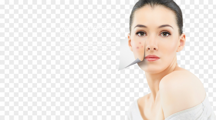Acne Skin Care Health Therapy PNG