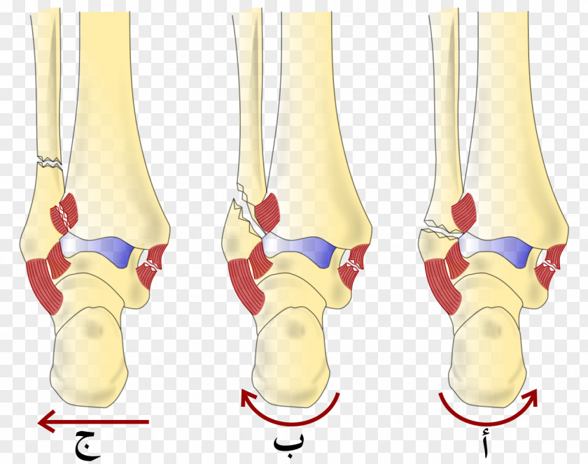 Webber Books Danis–Weber Classification Ankle Fracture Lauge-Hansen Bone Malleolus PNG