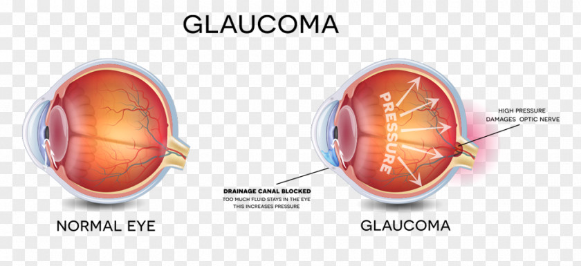 Eye Glaucoma Vision Loss Examination Care Professional PNG