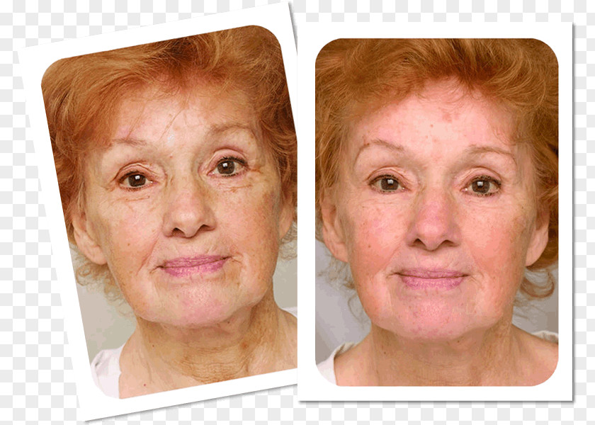 Attractive Appearance Wrinkle Anti-aging Cream Laser Surgery Skin PNG