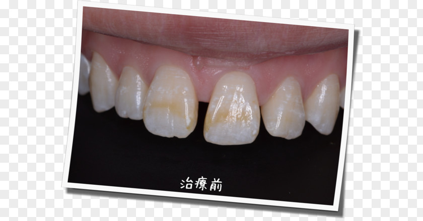 Dental Postcard 脱灰 Tooth Decay Enamel Therapy PNG