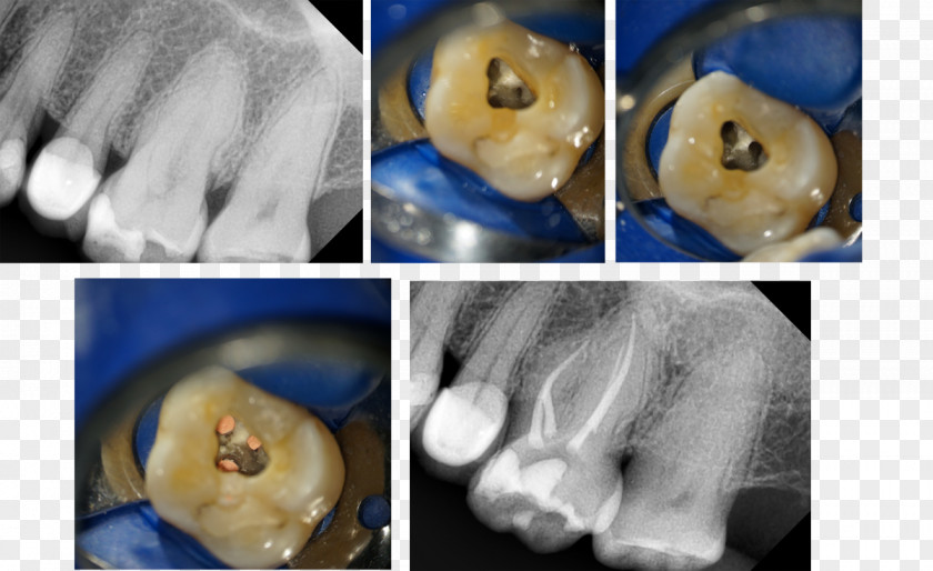 Endodoncia Endodontic Therapy Microscope Neurosurgery Ophthalmology Jaw PNG