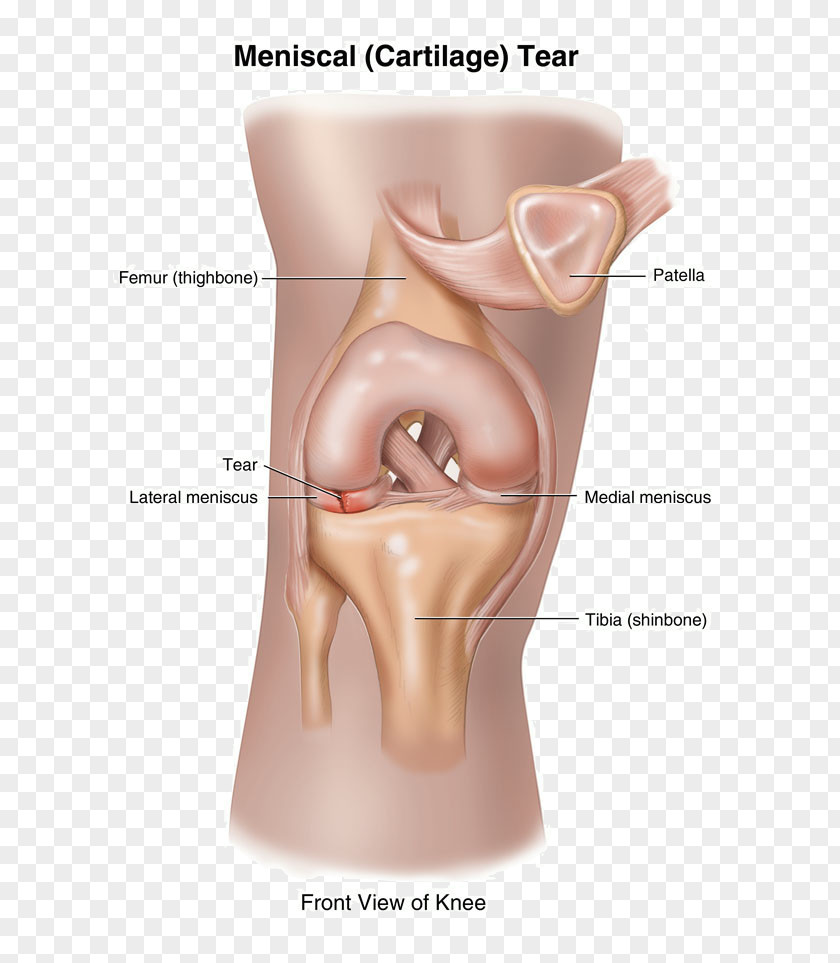Tear Of Meniscus Knee Pain Ruptur PNG