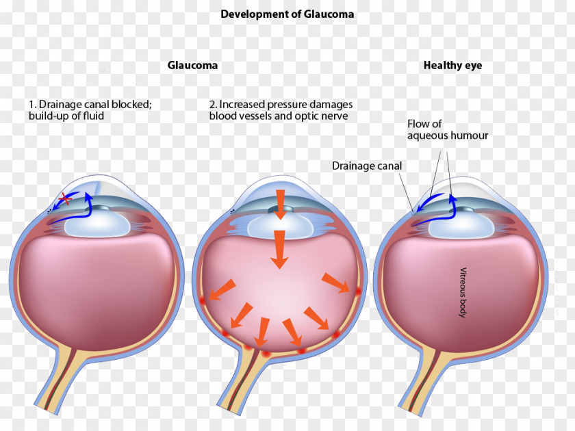 Aqueous Glaucoma Laser Surgery Eye Disease Ophthalmology PNG