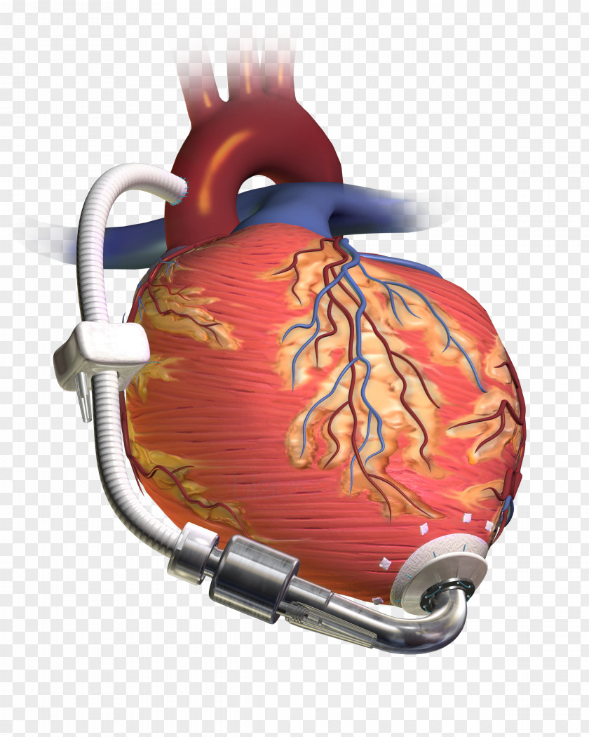 Left Ventricle Ventricular Assist Device Heart Transplantation Artificial PNG