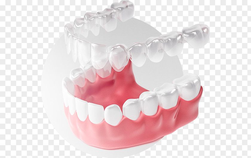 Smile Tooth Элайнер Dental Braces Clear Aligners Zwarcie PNG