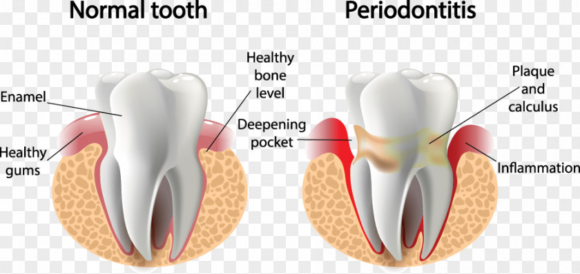 Health Periodontal Disease Gums Gingivitis Periodontology Dentistry PNG