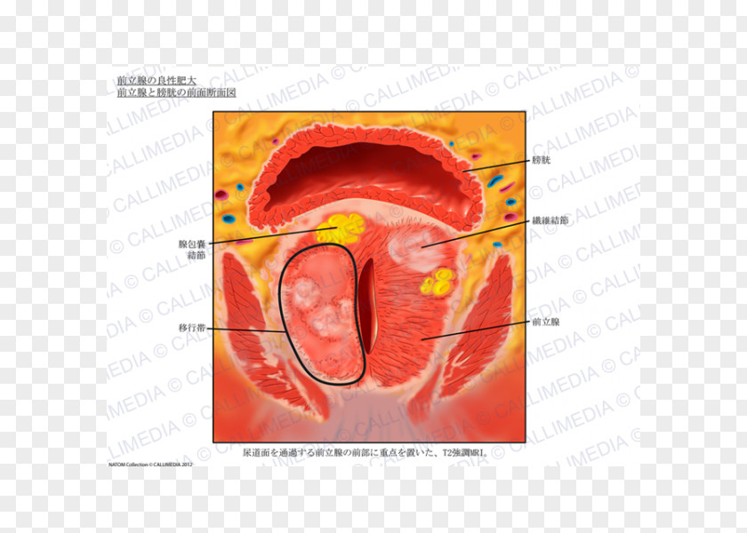 Bexiga Prostate Imaging Anatomy Magnetic Resonance Urinary Bladder PNG