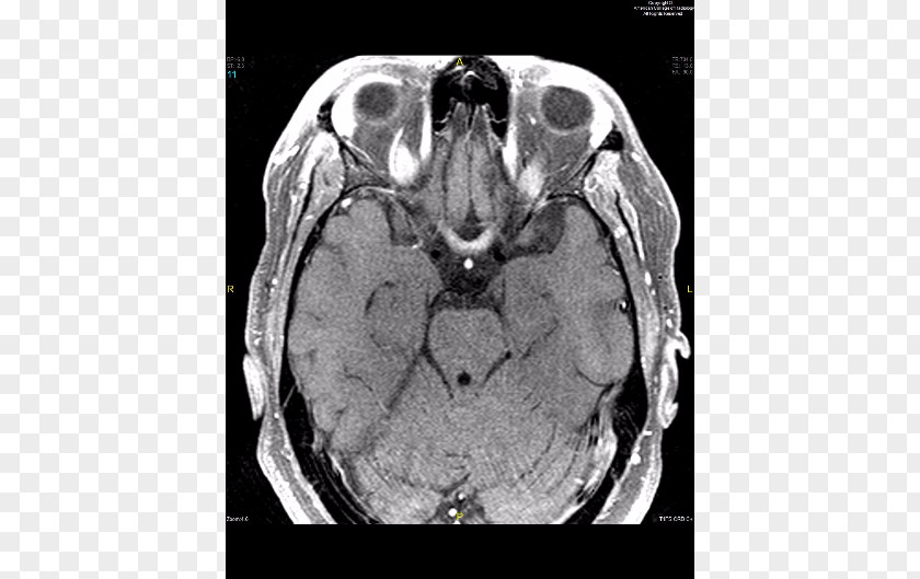 Brain Neuromyelitis Optica Spinal Cord Magnetic Resonance Imaging Neurology White Matter PNG