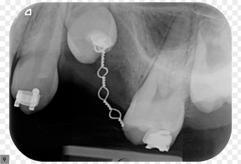 Tooth Alveolar Consonant Dental Implant Extraction PNG