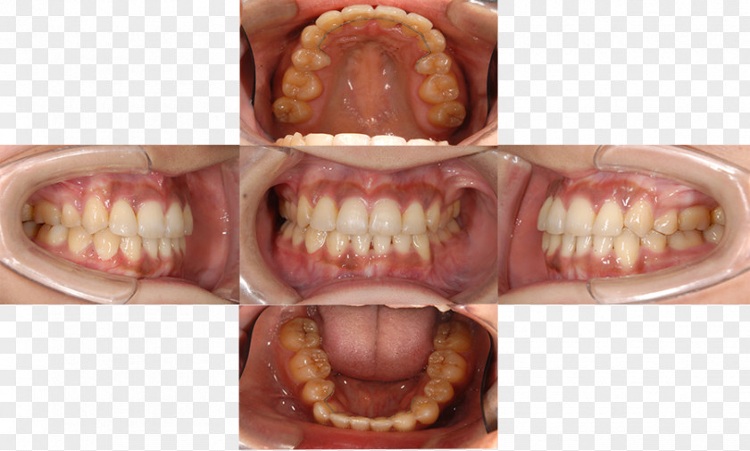 Orthodontic Correction Tooth Periodontal Disease Dentistry Medical Specialist 日本歯周病学会認定歯周病専門医 PNG