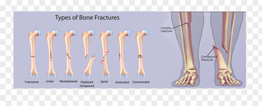 Bone Fracture Comminution Joint Pathologic PNG