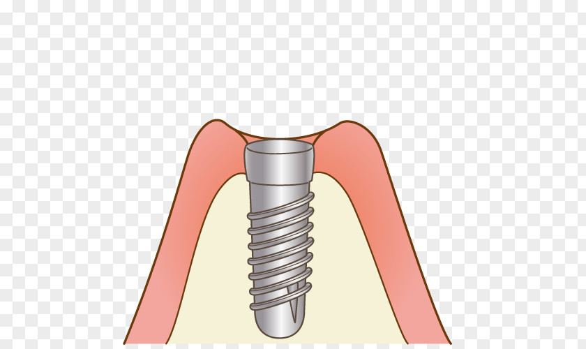 Implant Dentistry 審美歯科 Dentist 矯正歯科 けやき歯科クリニック PNG