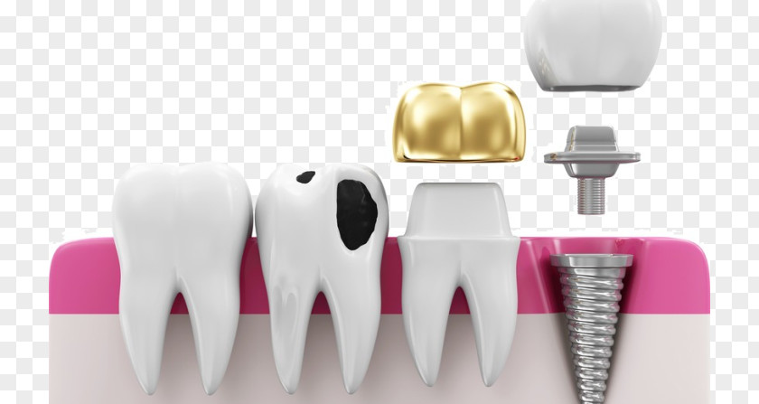 Crown Dentistry Dental Implant Bridge PNG