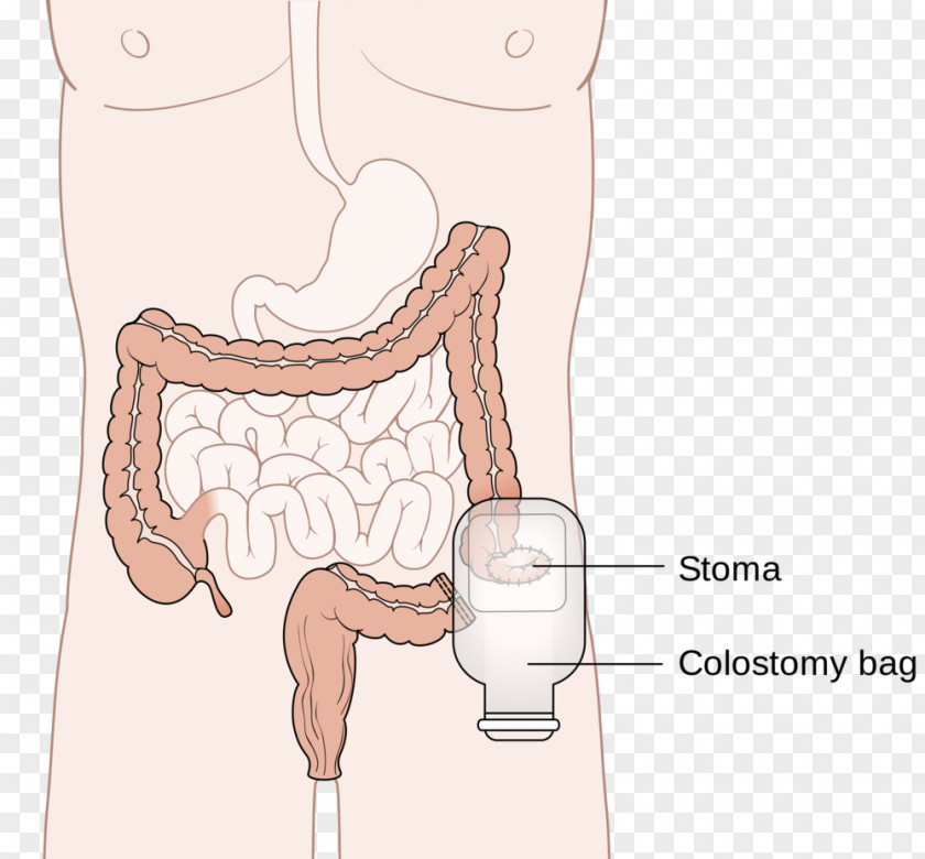5 X 1000 Colostomy Colectomy Surgery Ileostomy Stoma PNG