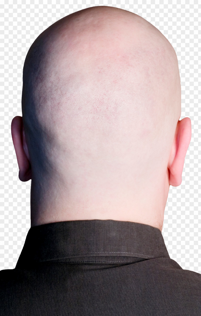 Back Forehead Chin Neck Hair Loss PNG