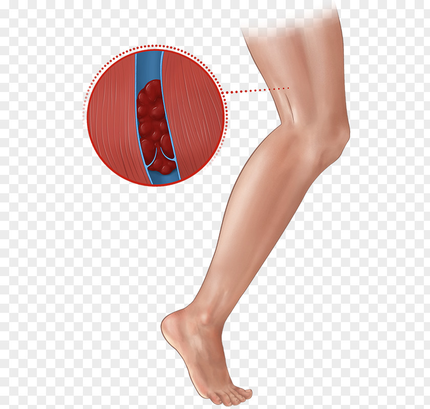 Deep Vein Thrombosis Human Leg Thigh Thrombus PNG vein thrombosis leg Thrombus, legs clipart PNG