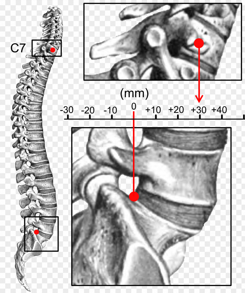 Spine Finger Retrolisthesis Kyphosis Sagittal Plane Vertebral Column PNG