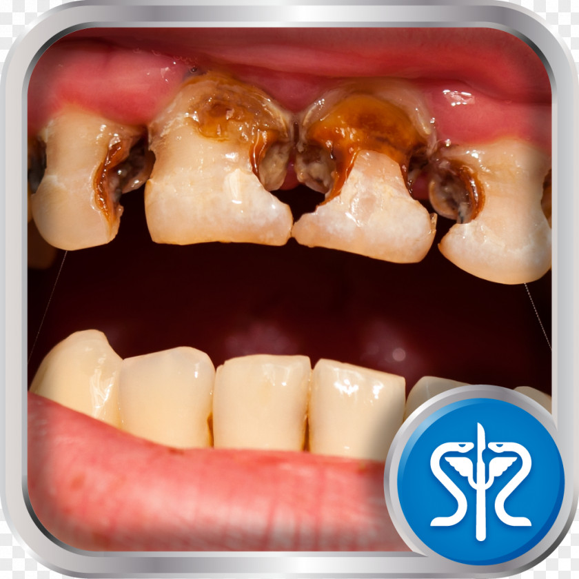 Health Tooth Decay Toothache Dentistry Medicine PNG