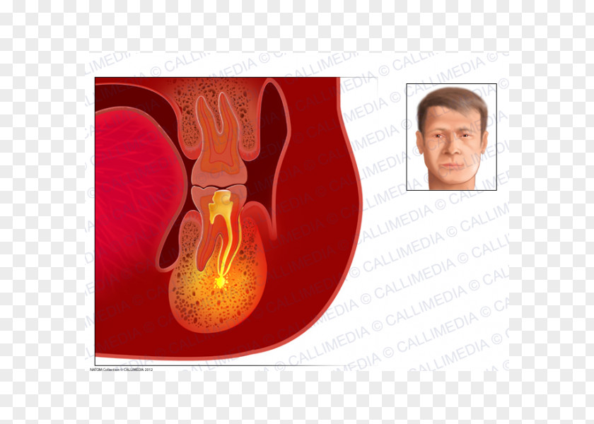 Dental Abscess Infection Periodontal Disease Tooth PNG