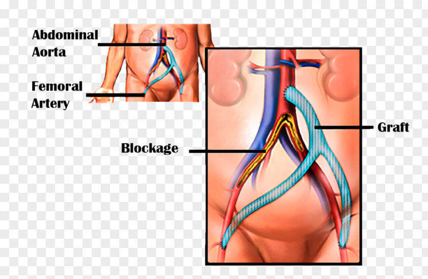 AIDS Vascular Bypass Coronary Artery Surgery Femoral Aorta Peripheral Disease PNG