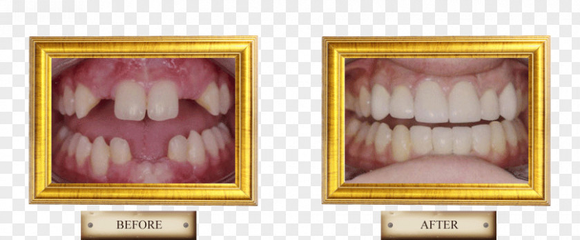 Dental Smile Tooth Picture Frames Health Tongue Beauty.m PNG