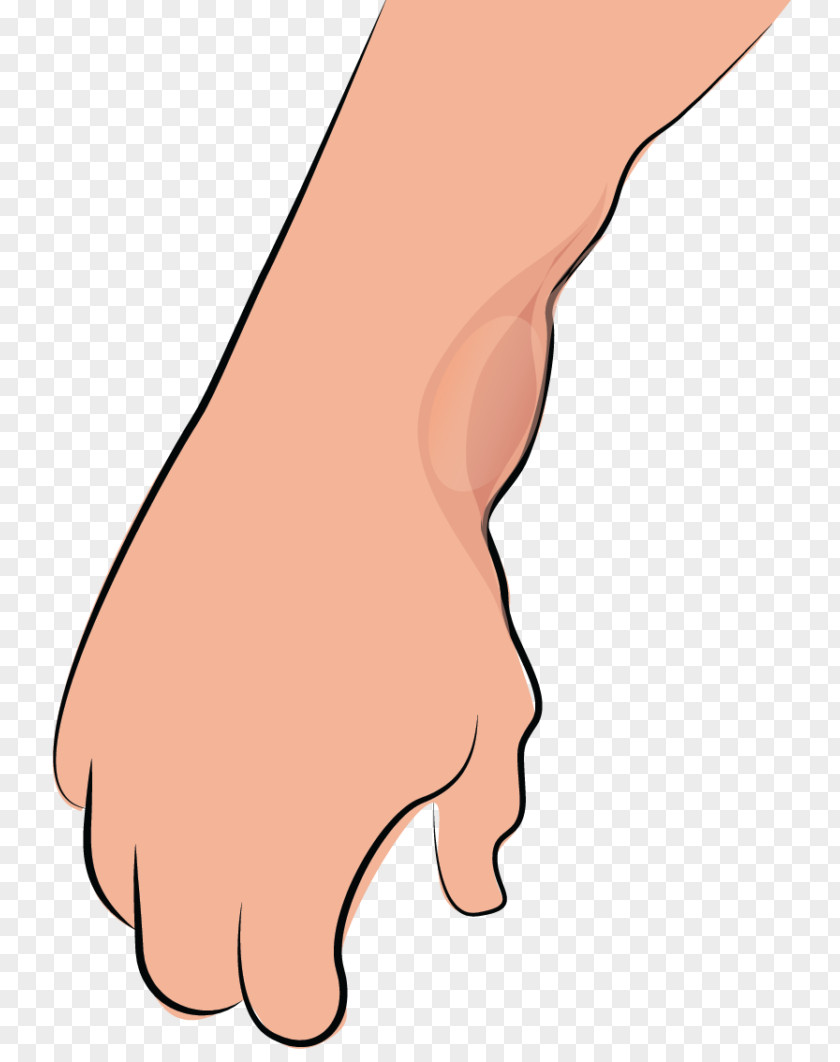 Ganglion Thumb Synovial Cyst Surgery Tendon PNG