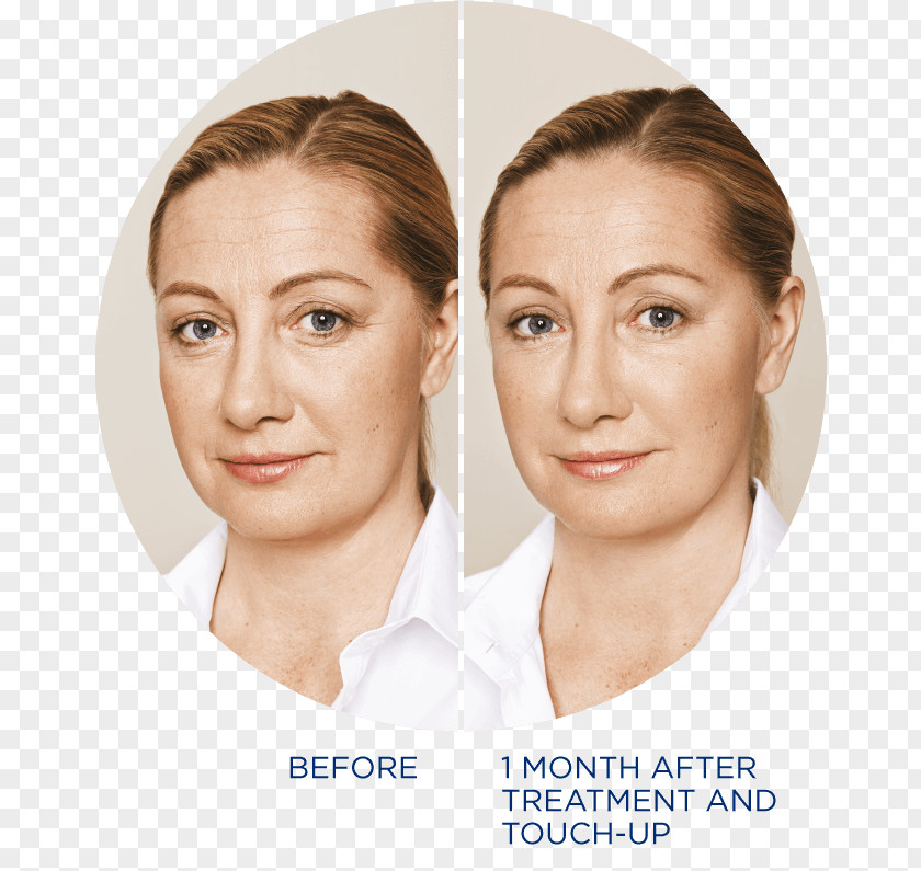 Eye Restylane Periorbital Puffiness Wrinkle Injectable Filler PNG