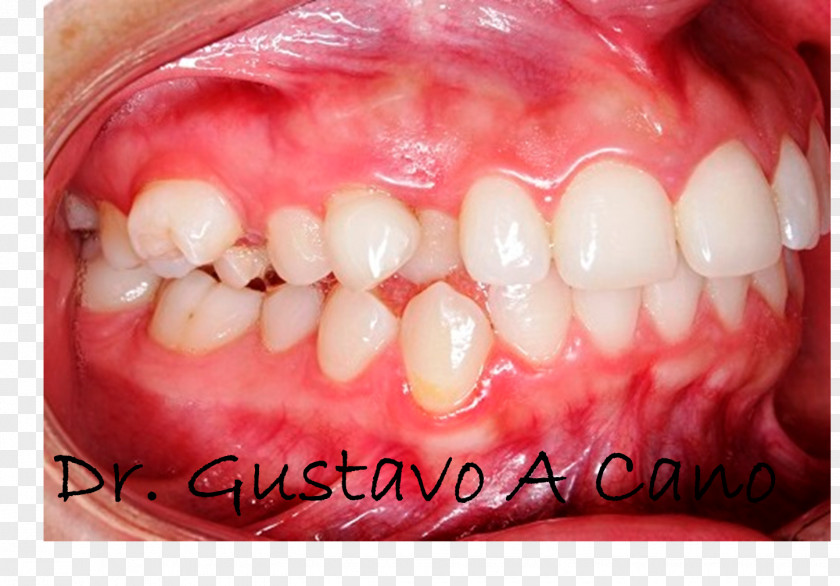 Orthodontic Tooth Maxillary First Molar Deciduous Teeth Eldgos PNG