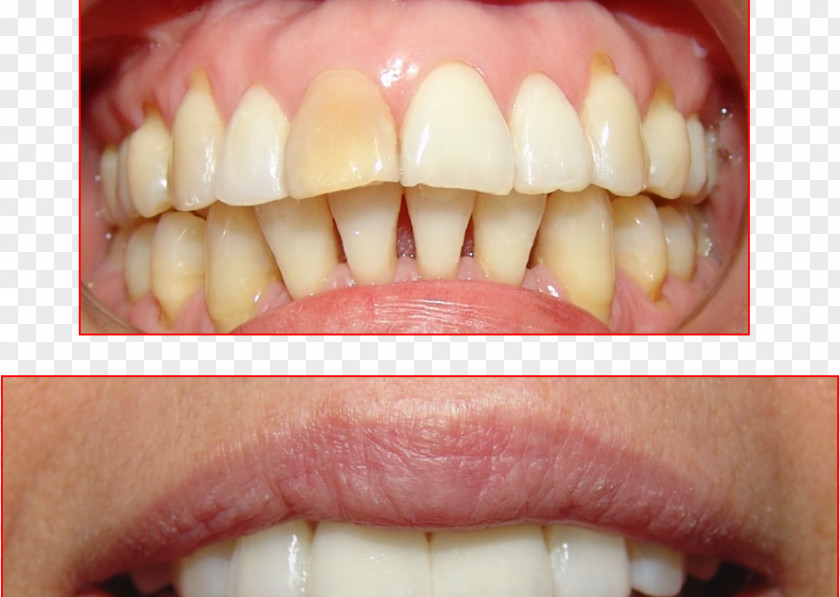 Tooth Ceramic Dental Restoration Resin Dentistry PNG