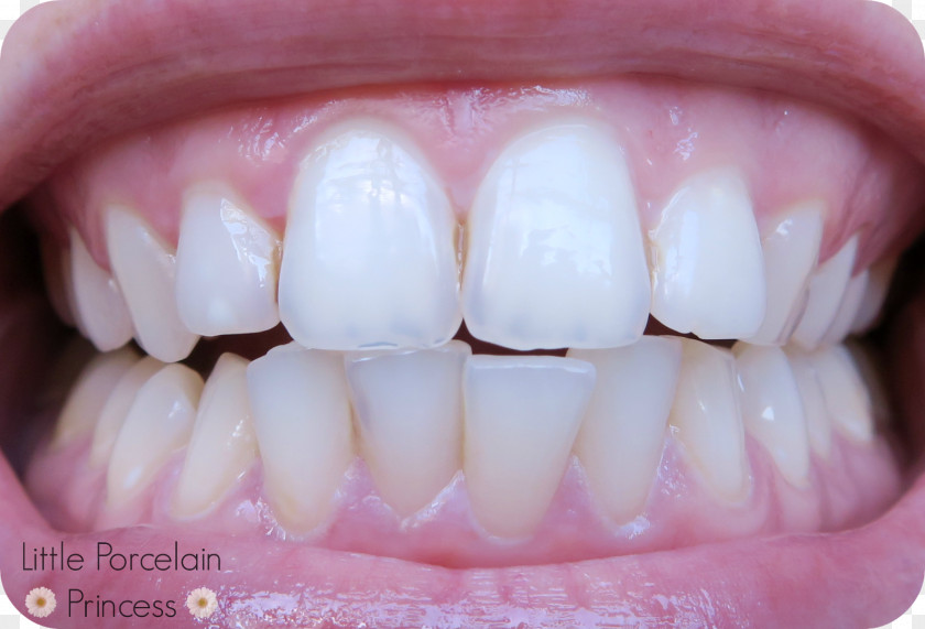 Whitening Freckle Tooth Gums Mouth Gel PNG