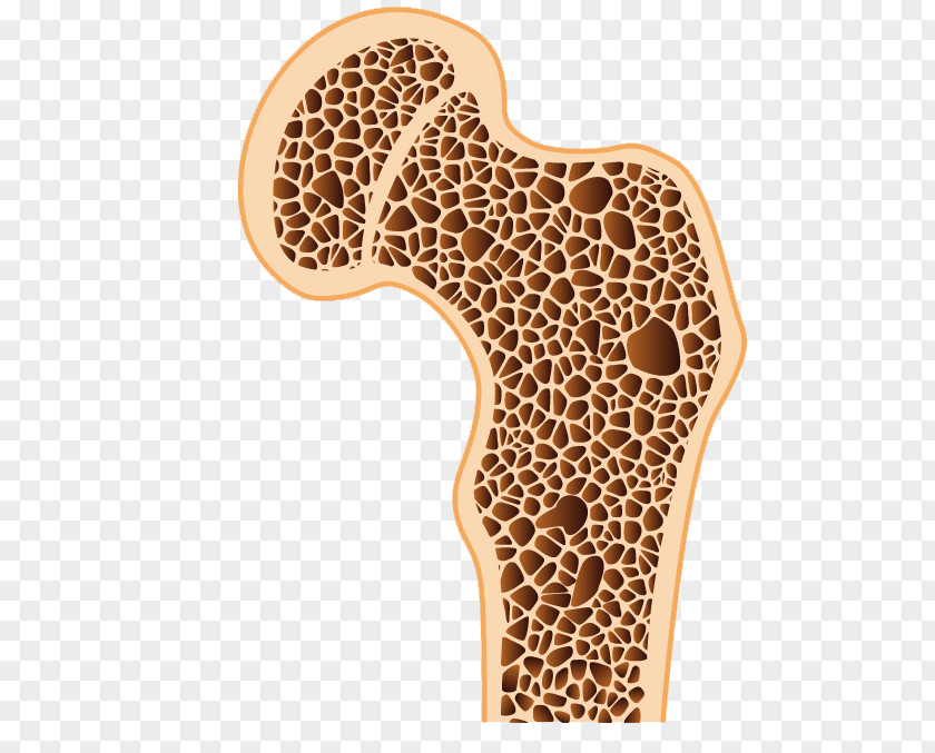 Bones Osteoporosis Bone Density Osteopenia Disease PNG