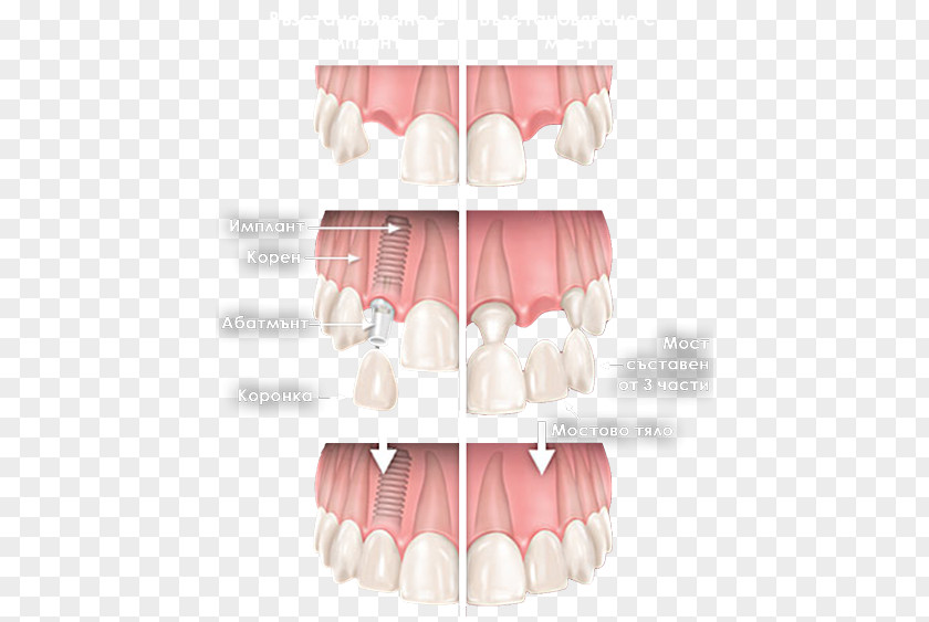 Tooth Cosmetic Dentistry Dental Implant Bruxism PNG