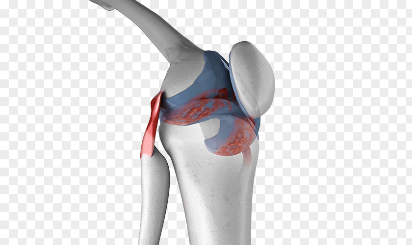 Arthritis Clipart Knee Pain Arthritic Joint PNG